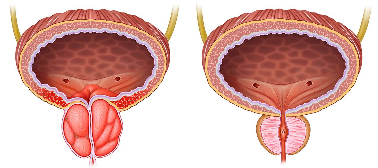 Prostată inflamată și sănătoasă după utilizarea capsulelor Predstonorm