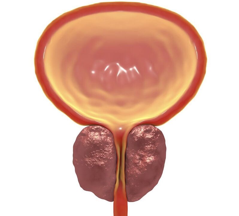 inflamația prostatitei cronice