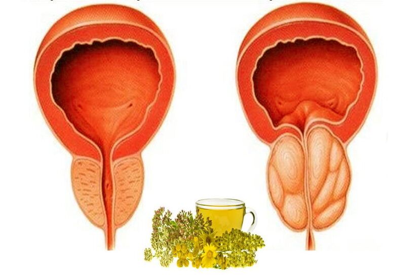 Prostată sănătoasă și dureroasă