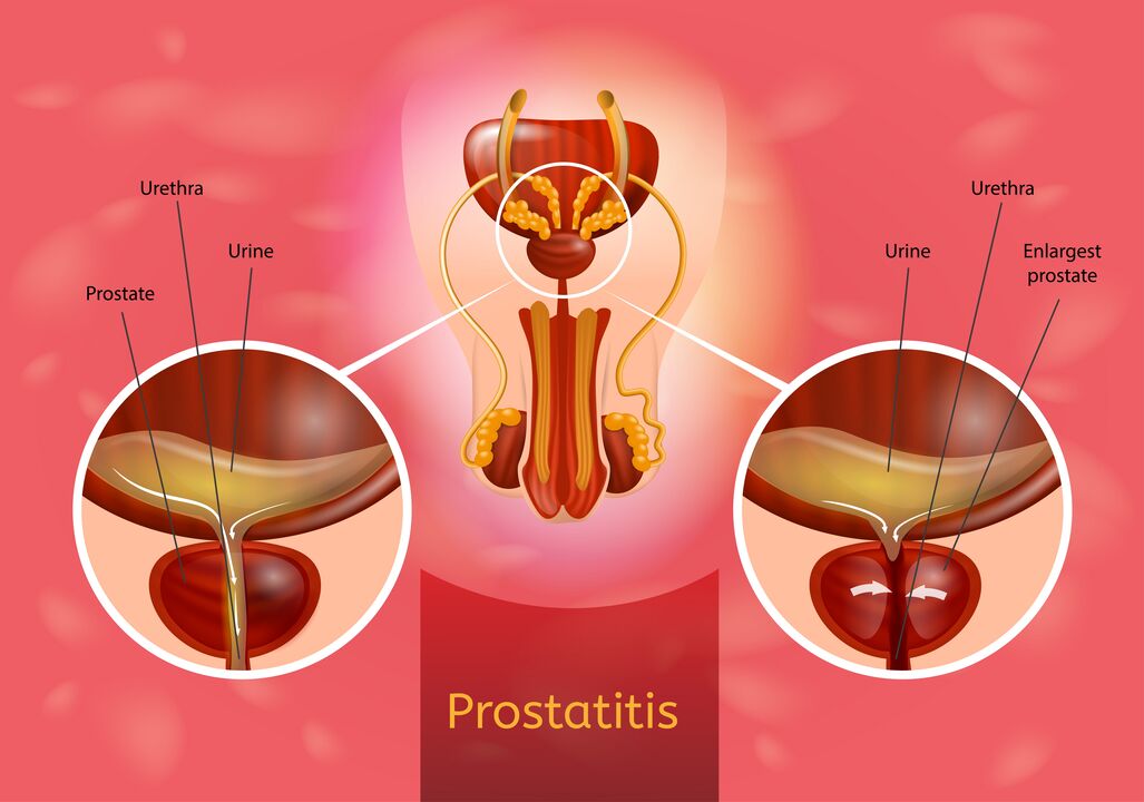 Prostatat