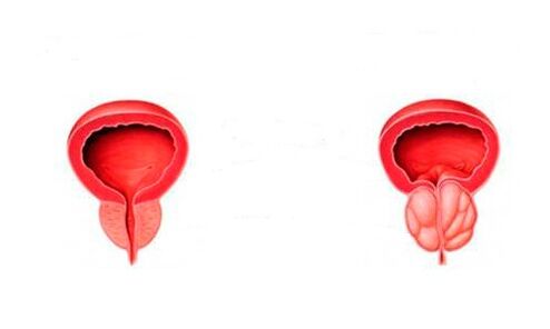 prostată sănătoasă și inflamată cu prostatita