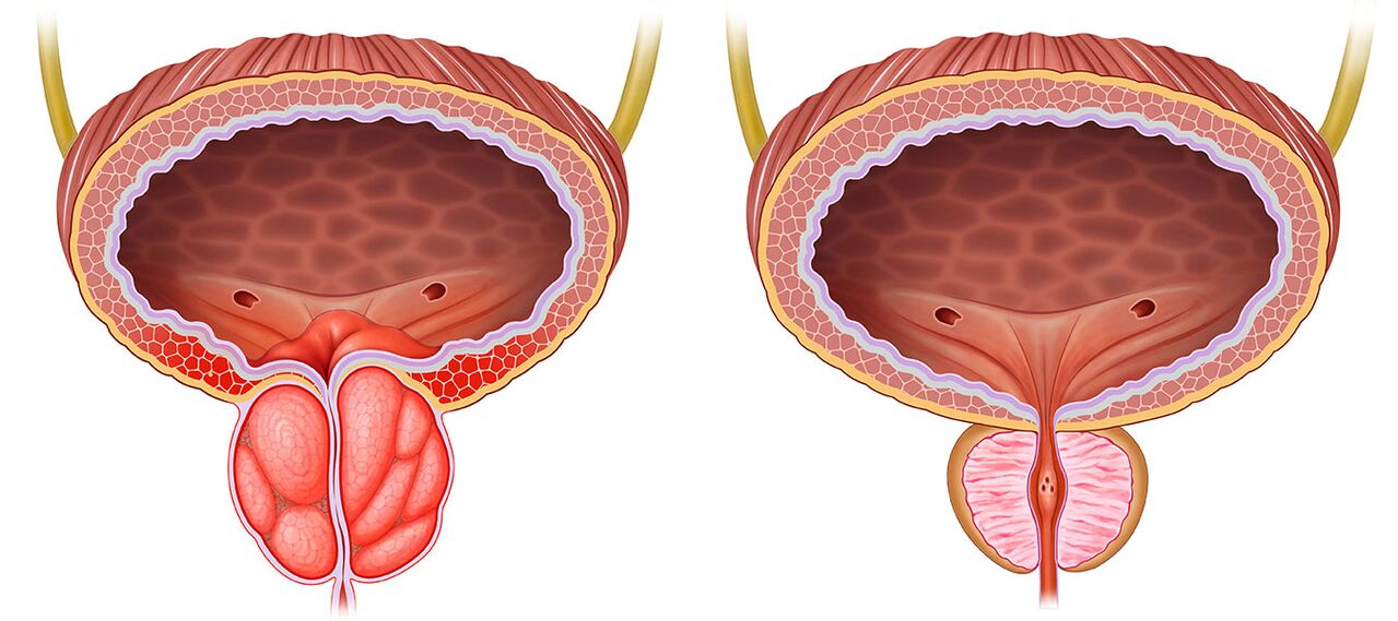 prostată inflamată și sănătoasă după utilizarea capsulelor Predstonorm